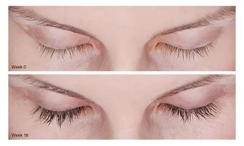before and after latisse