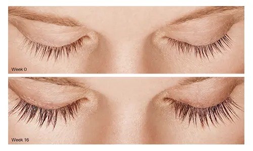 before and after latisse